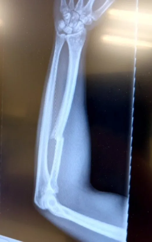 X-ray of a healed forearm with no hardware.
