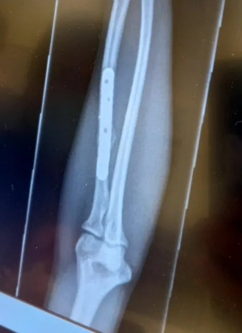 X-ray of a forearm with a metal plate and screws along the bone.